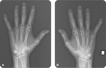rheumatoid arthritis radiology stages)