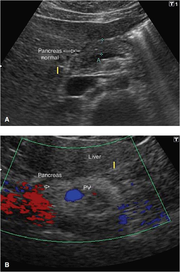 Ultrasound of the Pancreas | Radiology Key