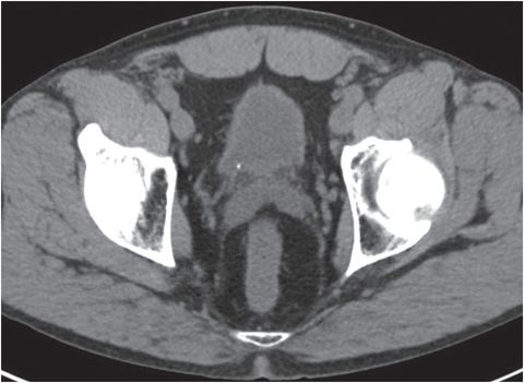 7 55-year-old man with right lower quadrant pain | Radiology Key