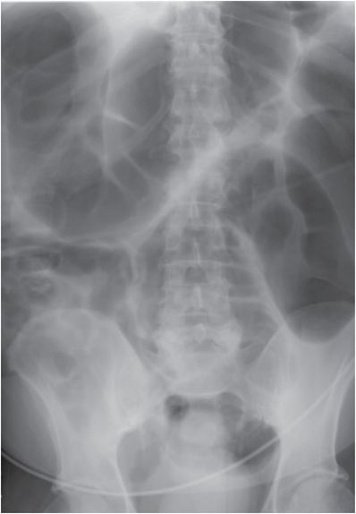 20 61-year-old woman presenting with diffuse abdominal pain, nausea ...