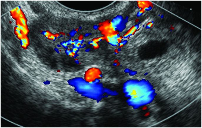 abnormal transvaginal ultrasound