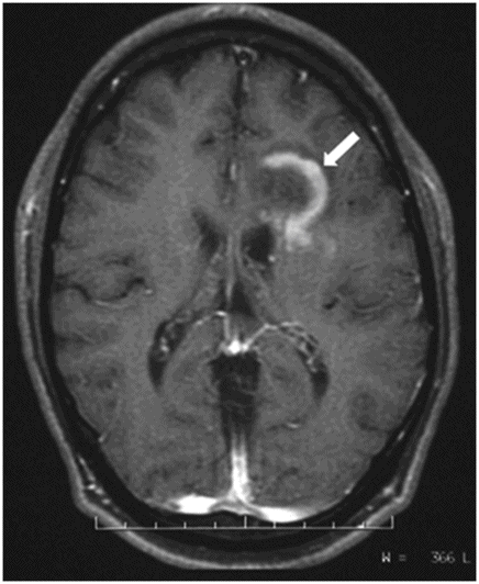 Frontiers | Neuroimaging and clinicopathological differences between  tumefactive demyelinating lesions and sentinel lesions of primary central  nervous system lymphoma