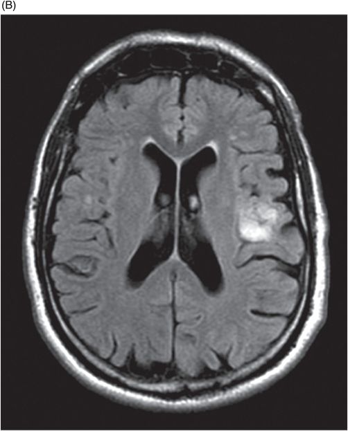 sylvian fissure mri