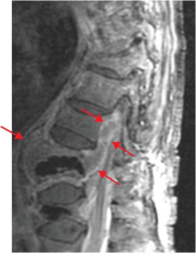 53 42-year-old female presenting with fever and back pain | Radiology Key