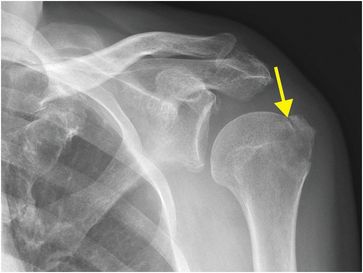 comminuted fracture greater tuberosity humerus