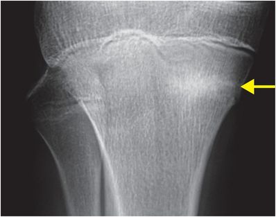 81 52-year-old male status post motorcycle trauma | Radiology Key