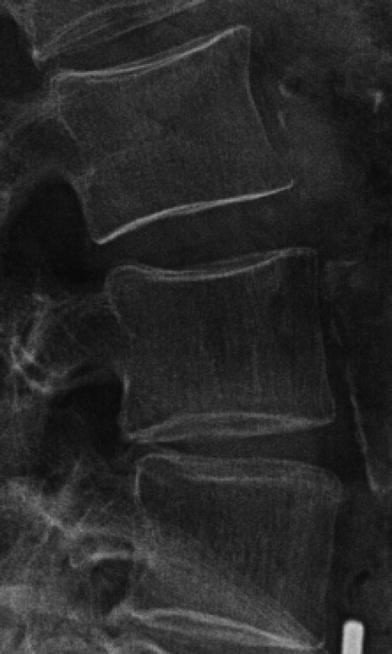 Semiquantitative (SQ) visual grading scheme for vertebral fractures.