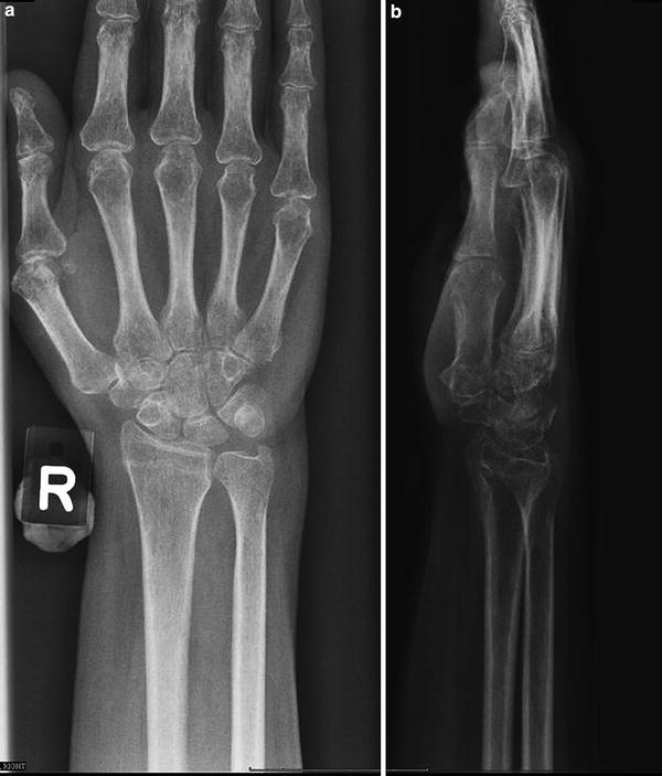 trabecular bone xray