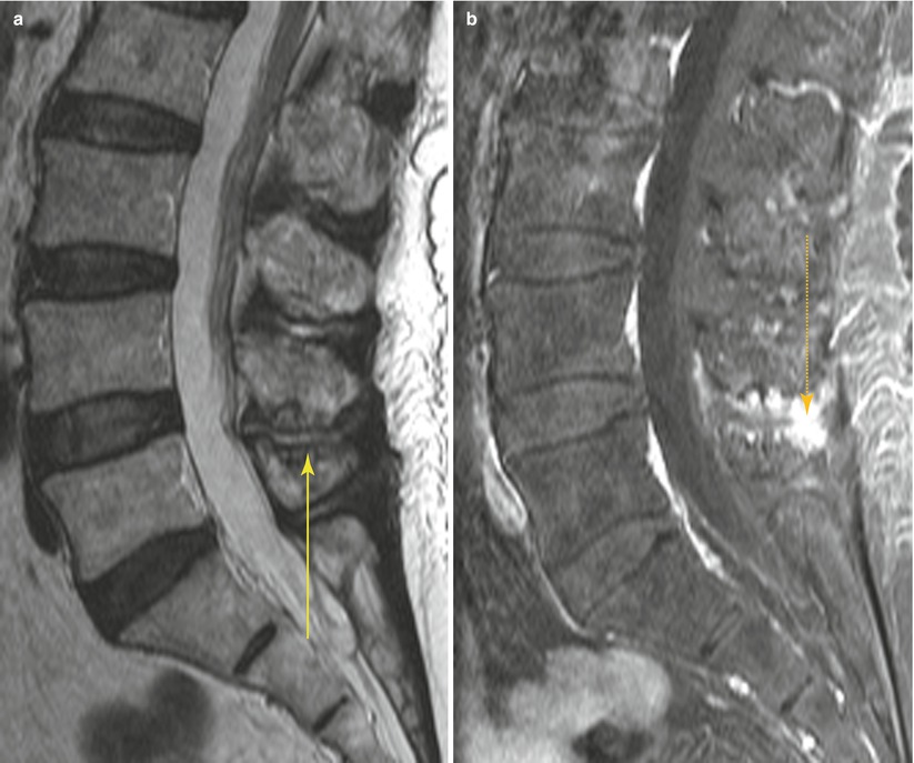 Common Spine Disorders Associated with Back Pain | Radiology Key