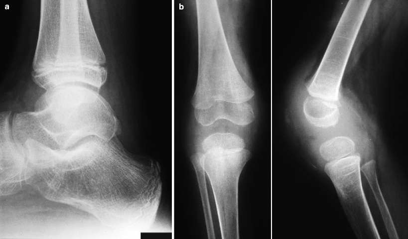 juvenile idiopathic arthritis radiology