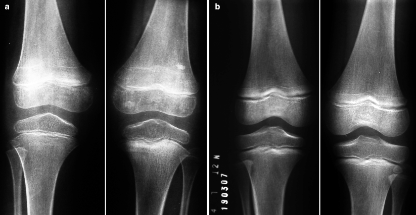 juvenile idiopathic arthritis radiology