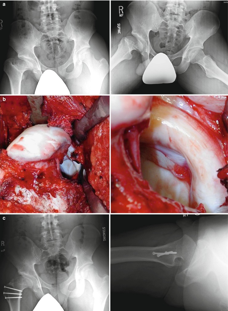 Legg-Calvé-Perthes Disease: Treatments | Radiology Key