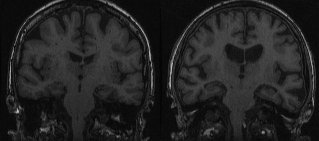 Structural Neuroimaging In Aging And Alzheimers Disease Radiology Key