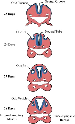 Congenital stapes suprastructure fixation presenting with