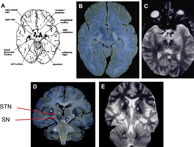 substantia nigra red nucleus