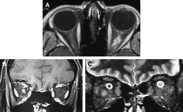 Nonconventional Optic Nerve Imaging In Multiple Sclerosis Radiology Key