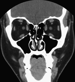 Extrathyroidal Manifestations of Thyroid Disease: Thyroid ...