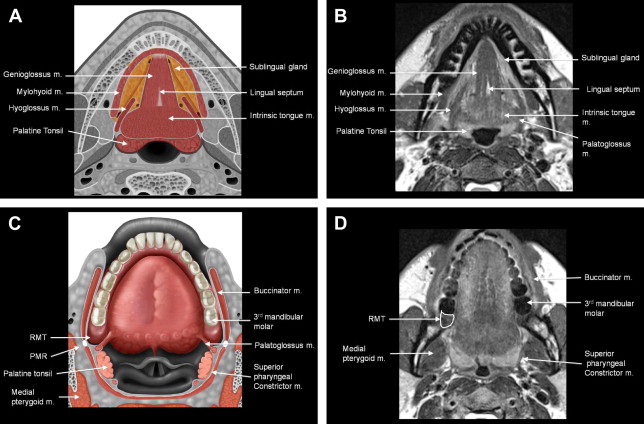 Pitfalls in the Staging of Cancer of Oral Cavity Cancer | Radiology Key
