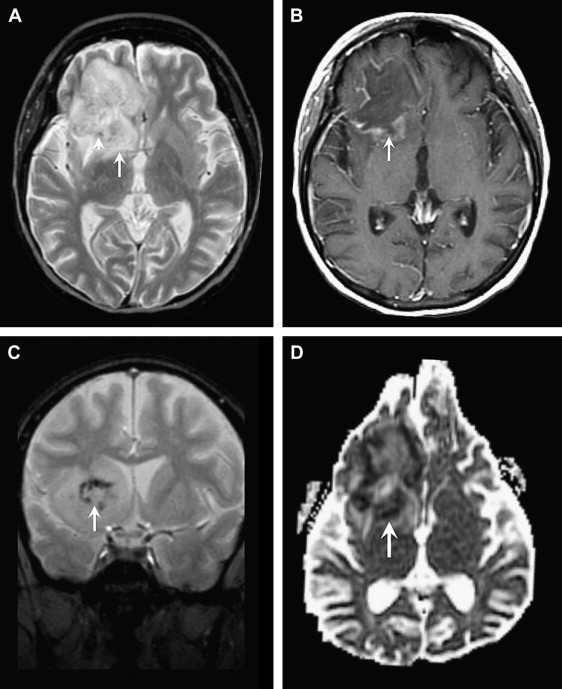 Central Nervous System Infection | Radiology Key