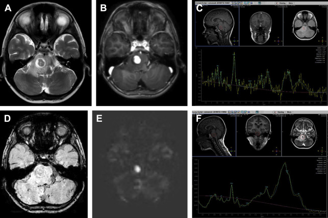 Advanced Mr Imaging In Pediatric Brain Tumors Clinical Applications