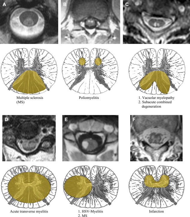 demyelinating-and-infectious-diseases-of-the-spinal-cord-radiology-key