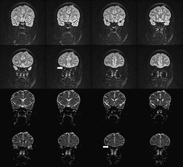 nonconventional-optic-nerve-imaging-in-multiple-sclerosis-radiology-key