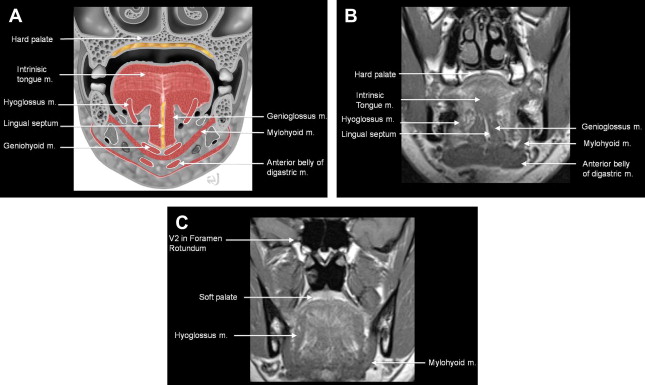 Pitfalls in the Staging of Cancer of Oral Cavity Cancer | Radiology Key