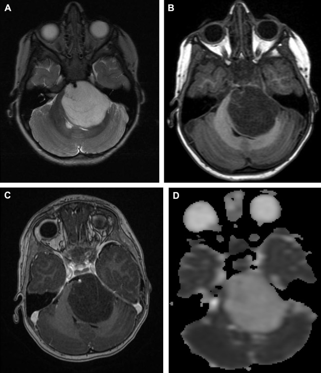 Advanced Mr Imaging In Pediatric Brain Tumors Clinical Applications