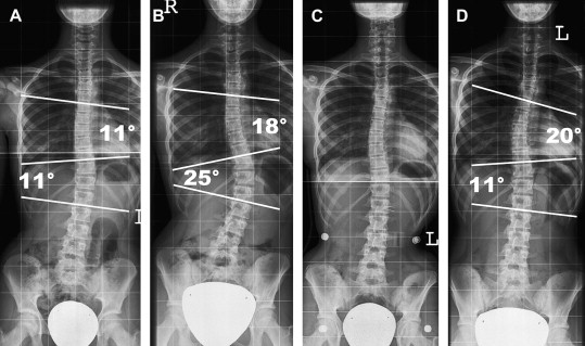 Severe Scoliosis X Ray