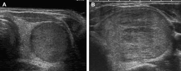 ultrasound-of-thyroid-nodules-radiology-key