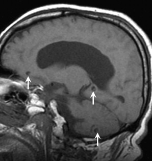 Central Nervous System Infection | Radiology Key