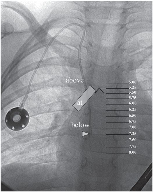 d : Case 1: The catheter is withdrawn, repositioning the chemo port tip