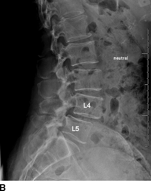 cervical spine x ray degenerative joint disease