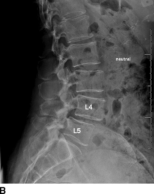 cervical-degenerative-disc-disease-cervical-ddd-mississauga-and