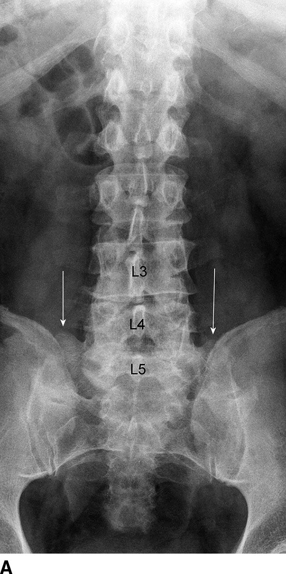 Degenerative Changes Of The Thoracic Spine