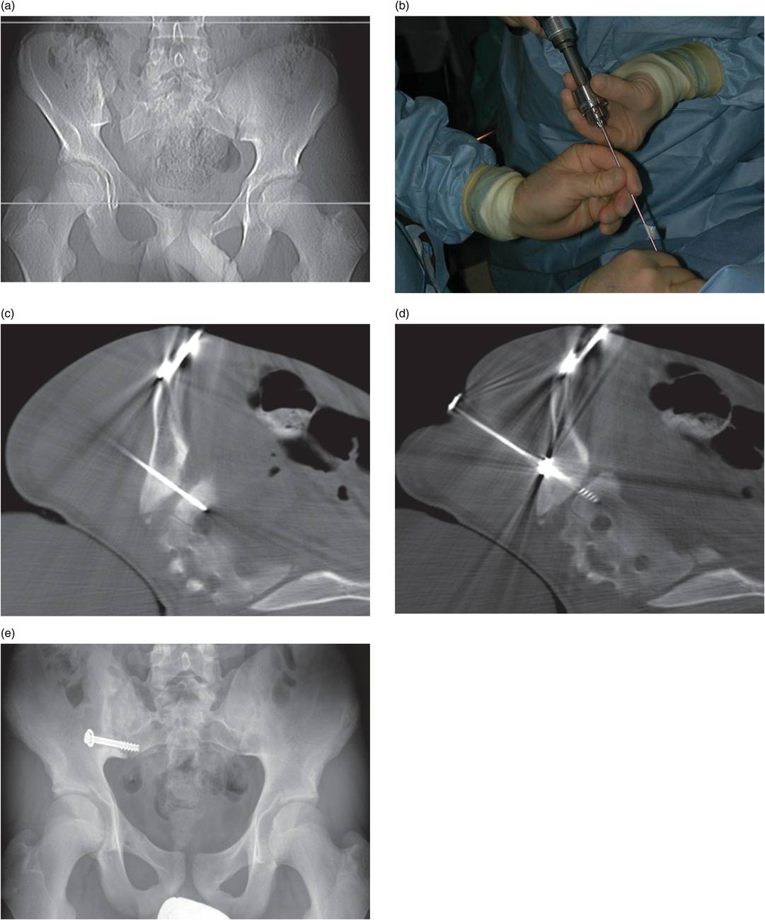 Musculoskeletal And Soft Tissue Interventions Radiology Key