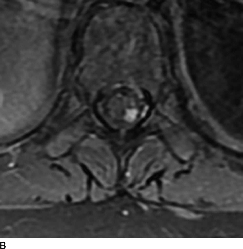 neoplastic-diseases-of-the-spine-radiology-key