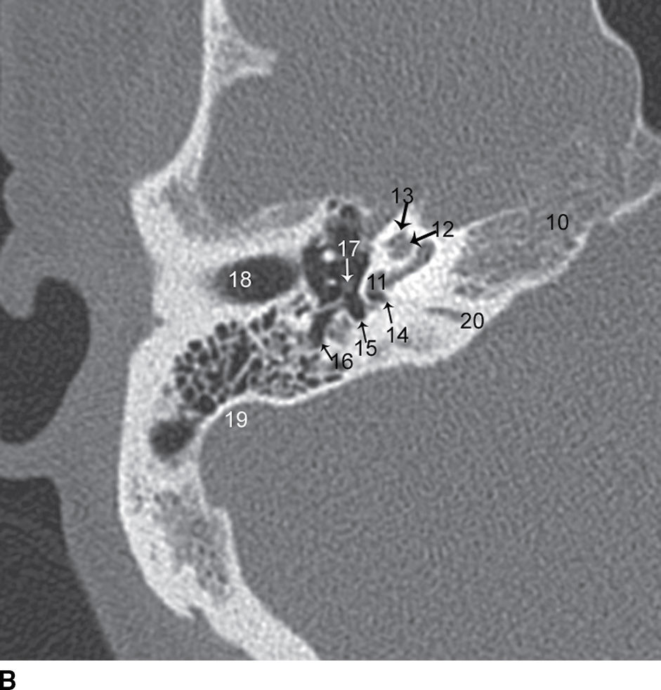 Temporal Bone Imaging Radiology Key 3771