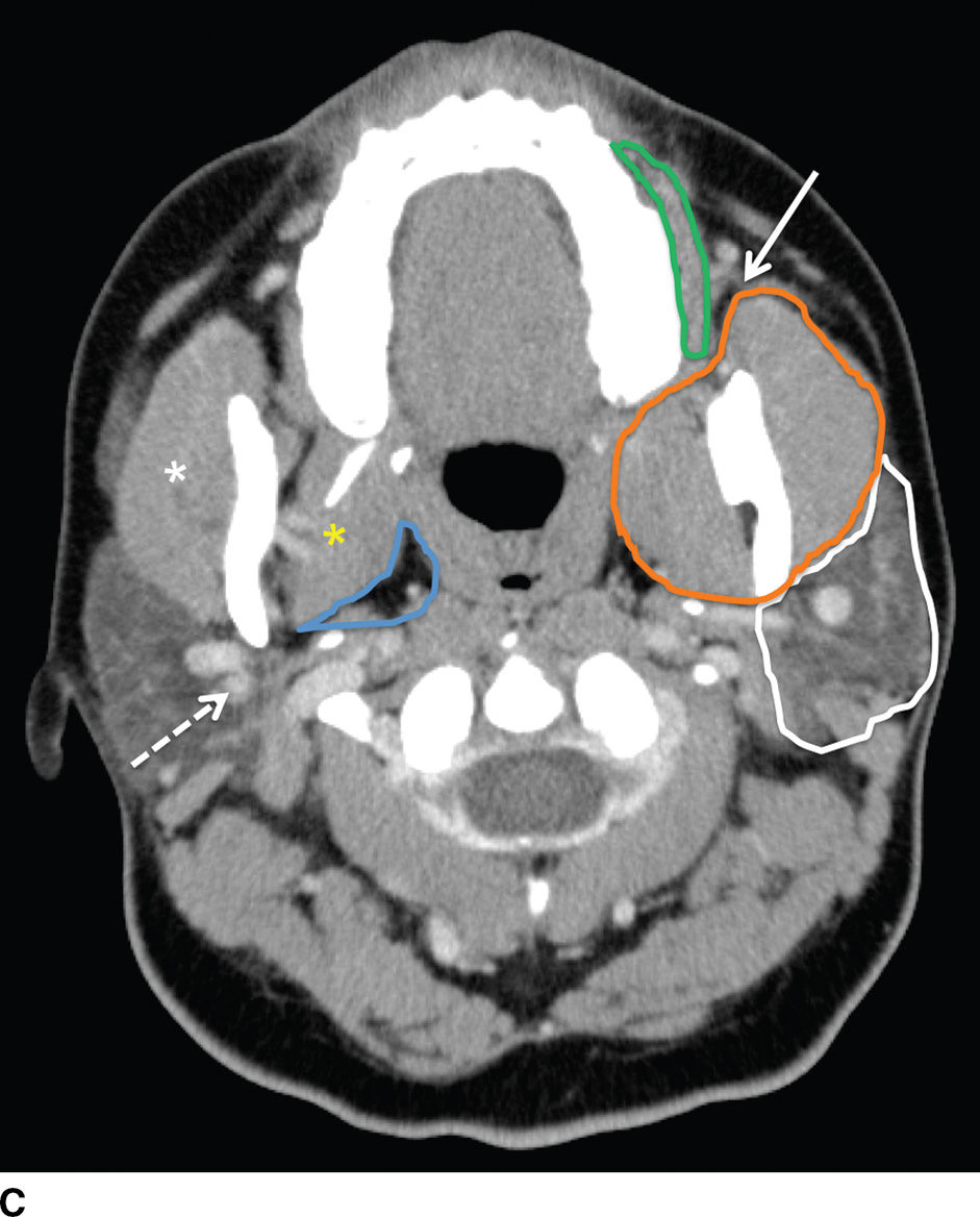 Parotid Gland Anatomy Ct Images And Photos Finder