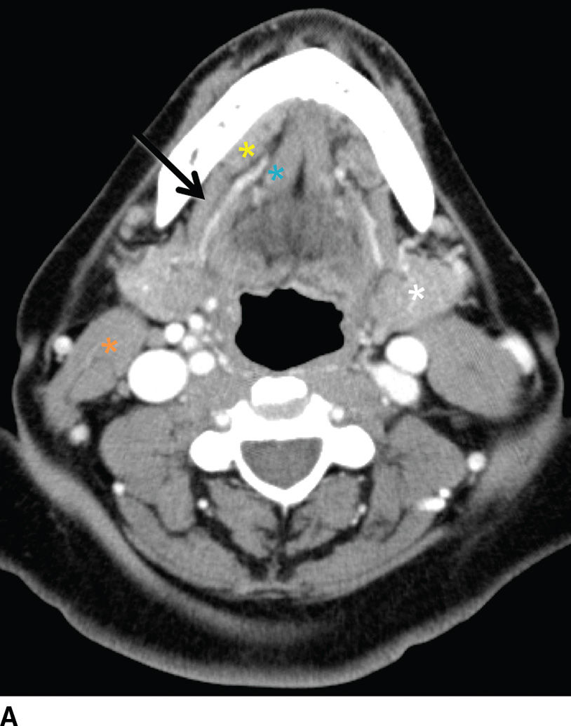 The Glands: Salivary, Thyroid, and Parathyroid Imaging | Radiology Key