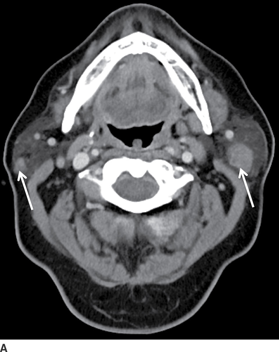 The Glands Salivary Thyroid And Parathyroid Imaging Radiology Key