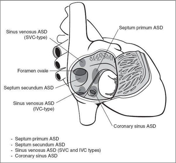 Ventricular And Atrioventricular Septal Defects Radiology Key