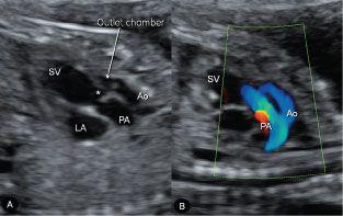 Cardiac Chambers | Radiology Key