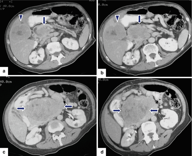 Pancreatic Neuroendocrine Neoplasms (PNENs) | Radiology Key