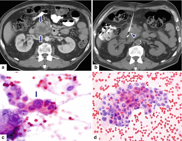 Pancreatic Ductal Adenocarcinoma Pdac Radiology Key