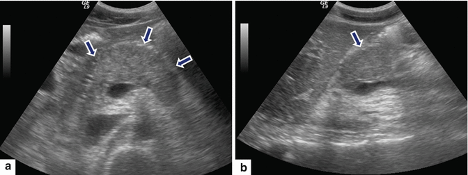Pancreatitis Ultrasound Appearance