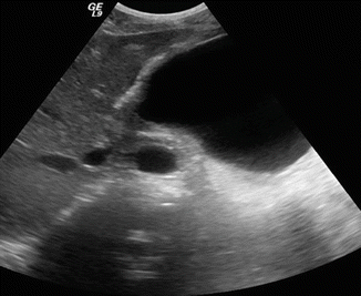 pancreatic pseudocyst ultrasound