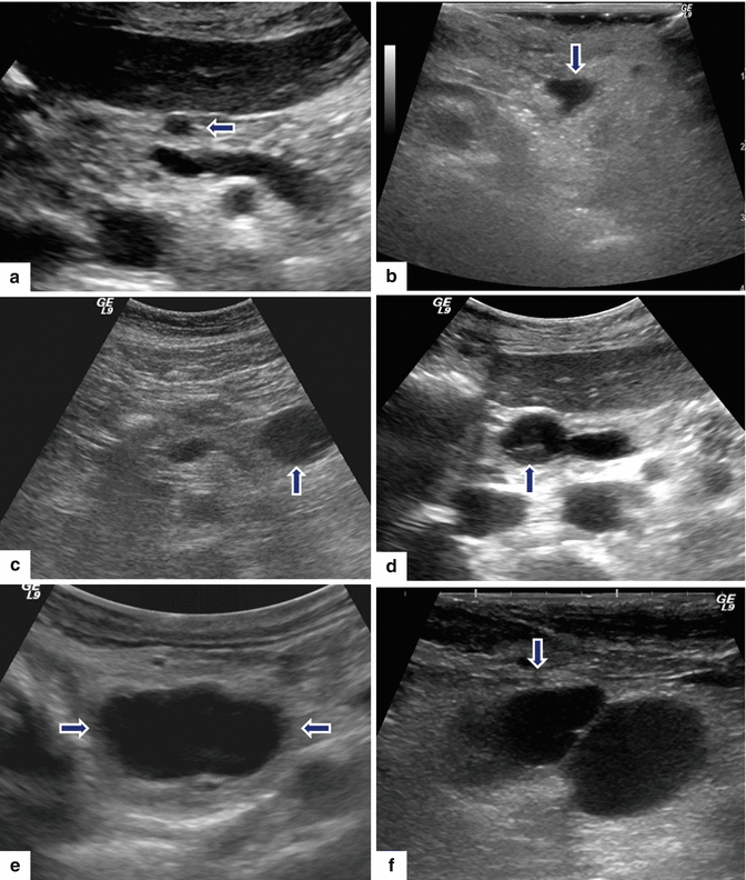 ct-scan-showing-low-grade-appendiceal-mucinous-neoplasms-with-liquid