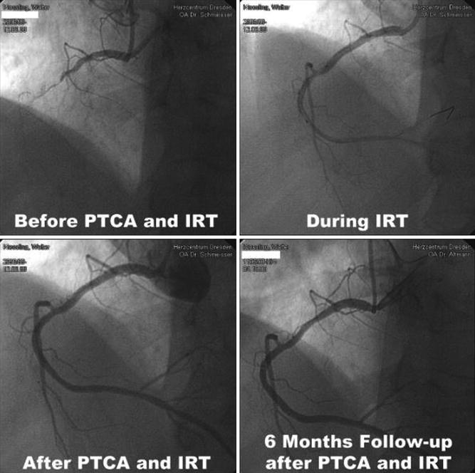 Inhibition Of Arterial Restenosis Following Balloon Angioplasty ...