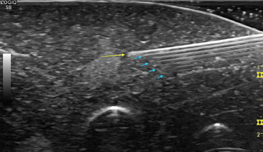 Tutorial 1 - Basic physics of ultrasound and the Doppler phenomenon | ICU  Sonography